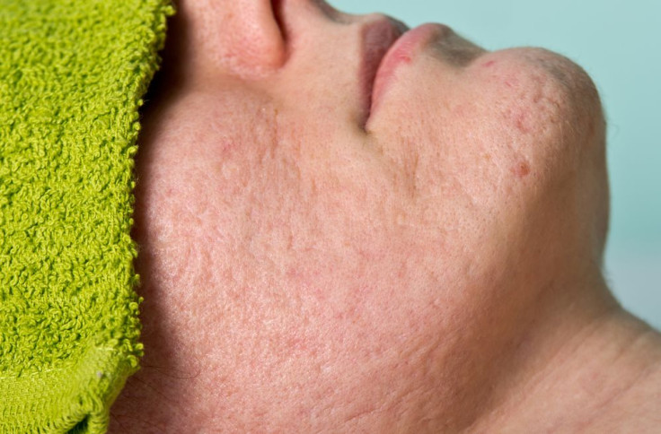 Acne Scarring