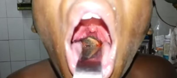 Boy has fish pulled from throat