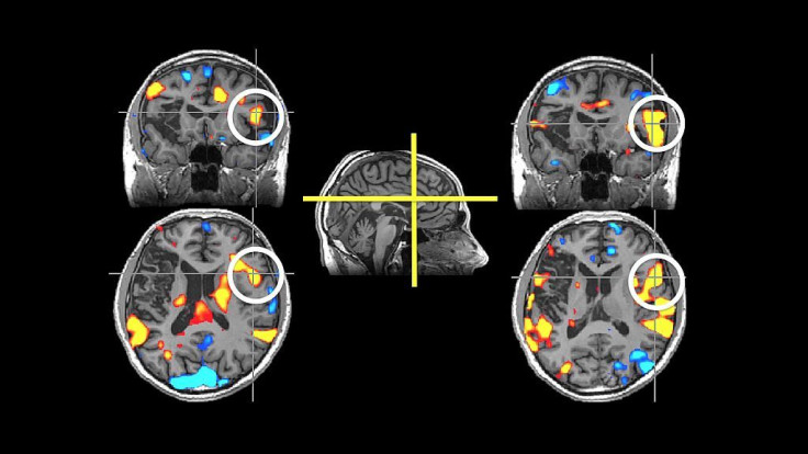 brain scan