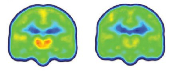 inflammationbrain