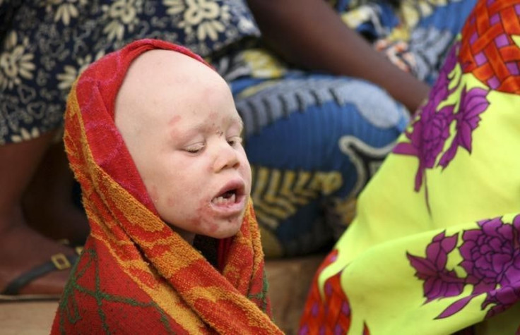 albino tanzania