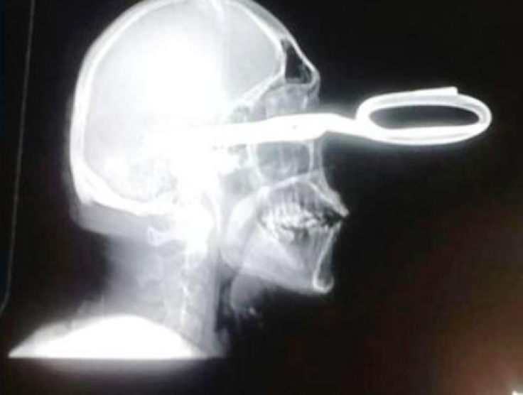 Scissor lodged in skull