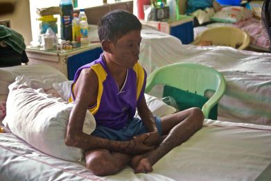 Leprosy sufferers worldwide face discriminatory laws affecting their right to work, travel and marry.