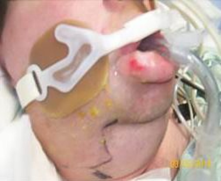 Man experiences severe swelling after huffing air duster
