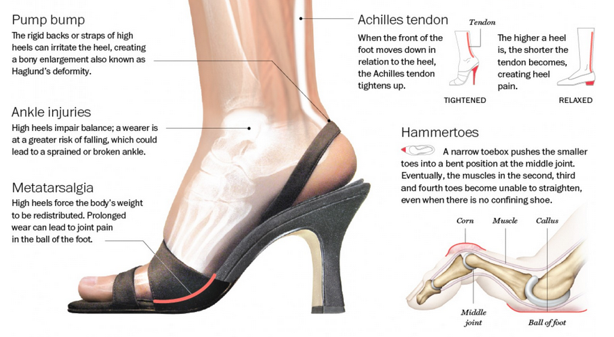How High Heels Cause Ankle Pain? | Visual.ly