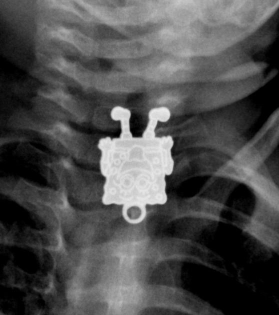 SpongeBob SquarePants found lodged inside toddler's throat