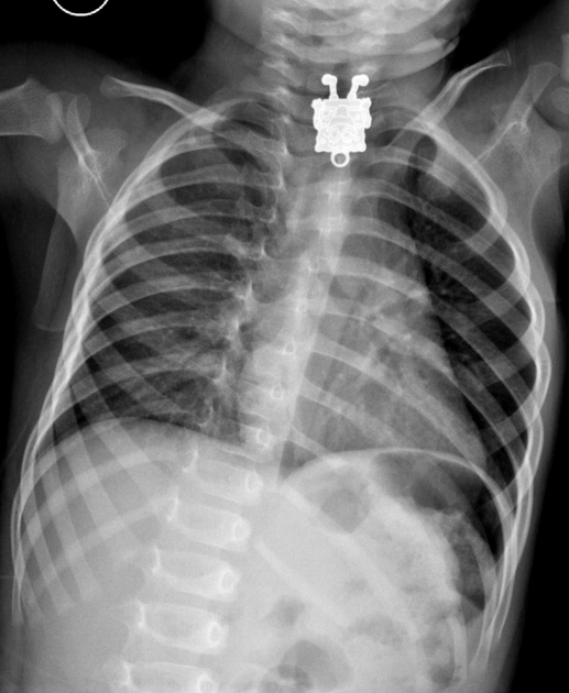 SpongeBob SquarePants found inside toddler's throat