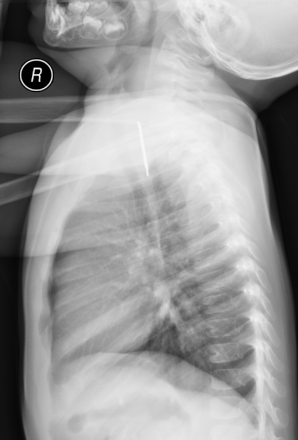 SpongeBob SquarePants found inside toddler's throat