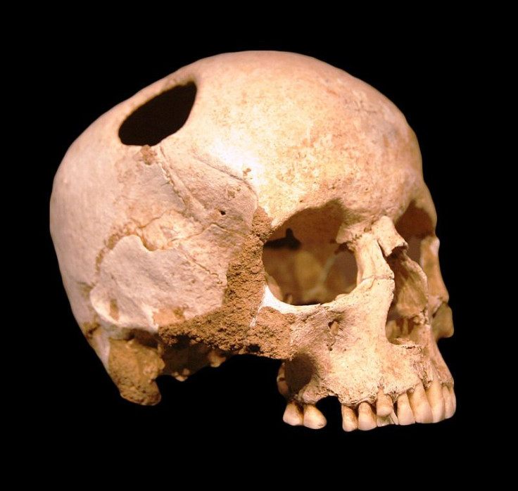 trepanation