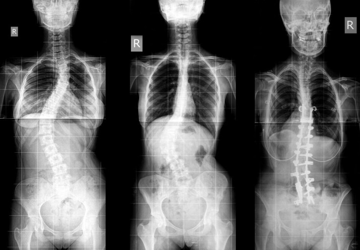 scoliosis