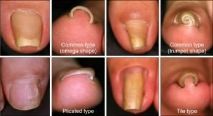 Medical Conditions Associated with Big Toe Nail Changing Color and Falling Off - wide 5