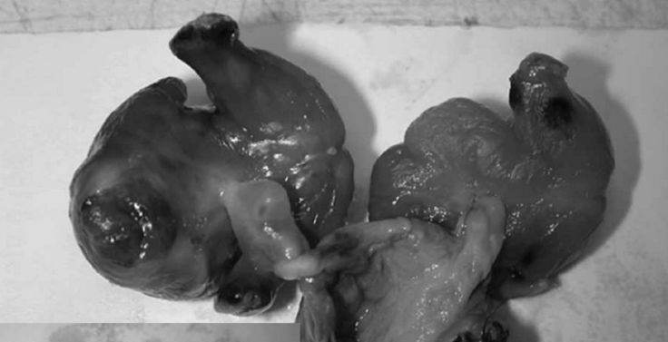 Twin fetuses inside newborn girl