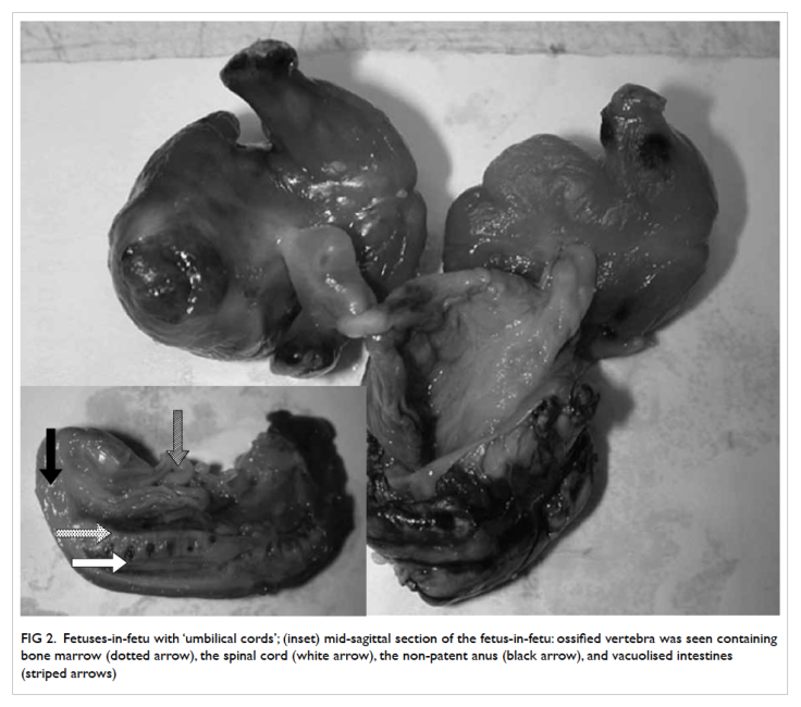 Fetuses-in-fetu with umbilical cords