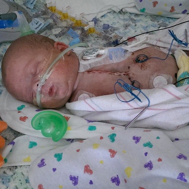 Premature Baby Gets Heart Transplant At Just 6 Days Old, Becomes ...