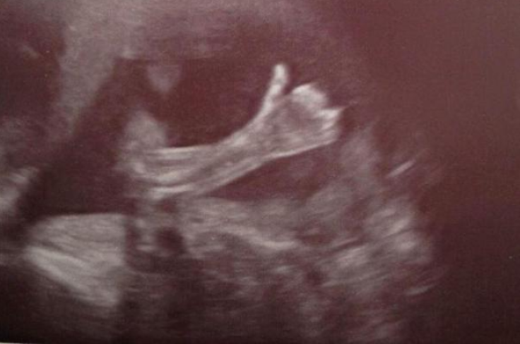 Baby gives thumbs up in ultrasound