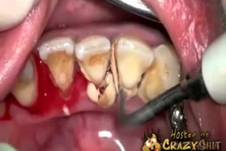 This is what happens to your teeth when you don’t visit the dentist for 10 years.