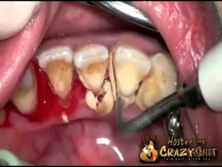 Dental Hygiene: Man With Gross Plaque On Teeth Visits Dentist Office After 10 Years