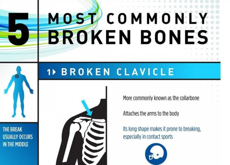 5 most commonly broken bones