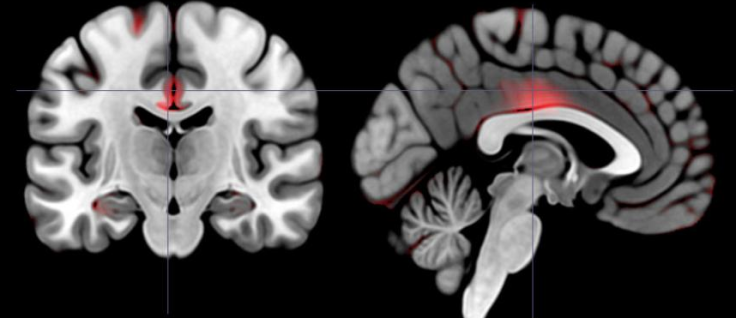 Brain scan shows differences in gray matter for extroversion personality types