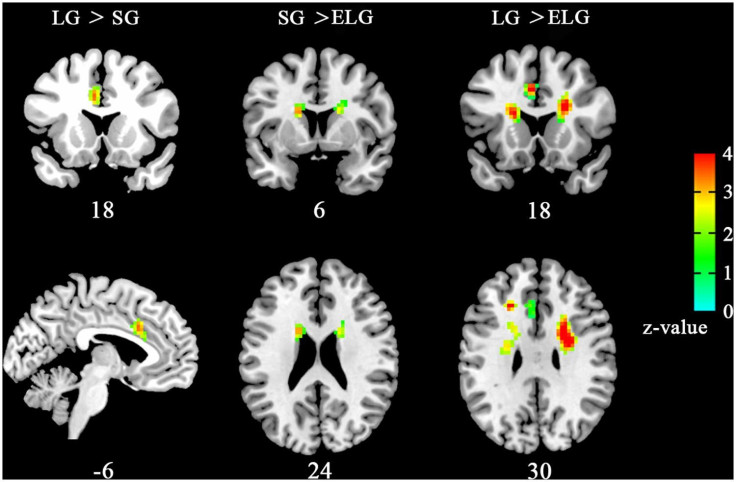 Brain scans of the in-love group and ended-love group