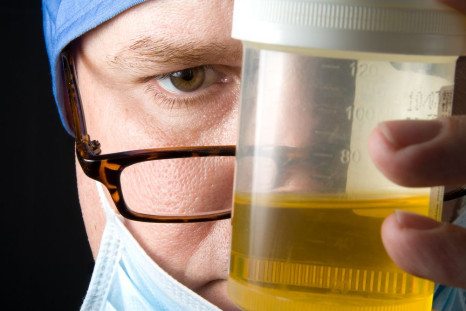 Kidney cancer detection could become as easy as a simple urine test.