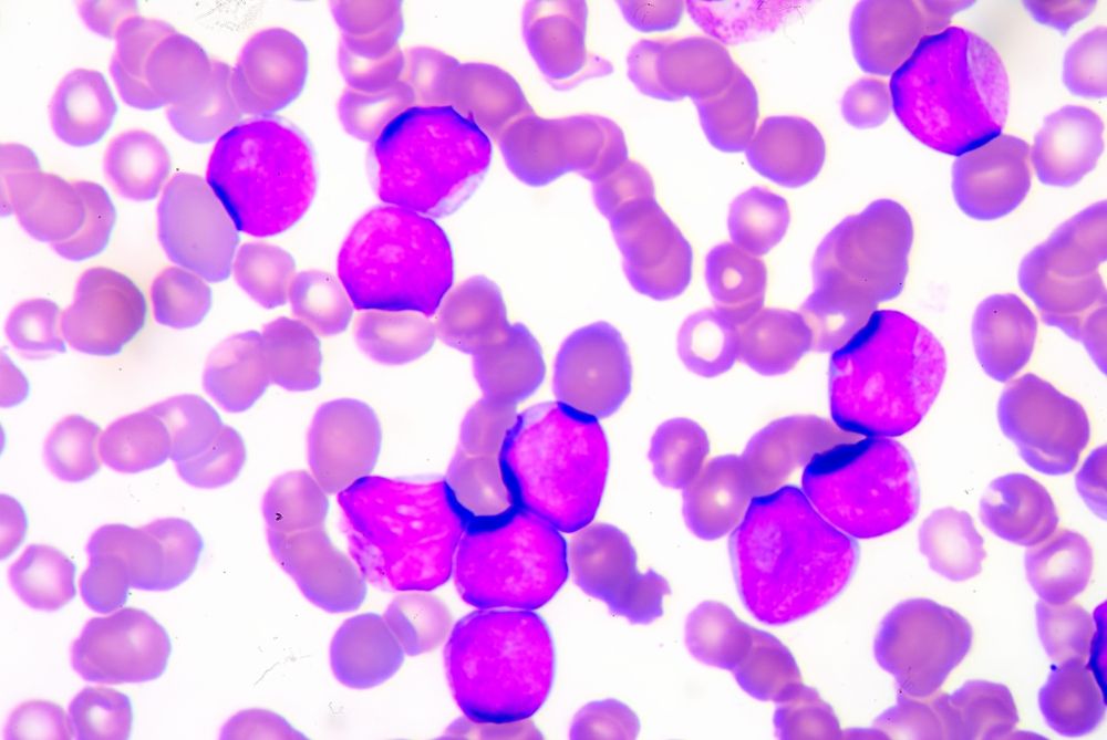 Leukemia Cells Become Harmless Immune Cells Before Scientists' Eyes ...