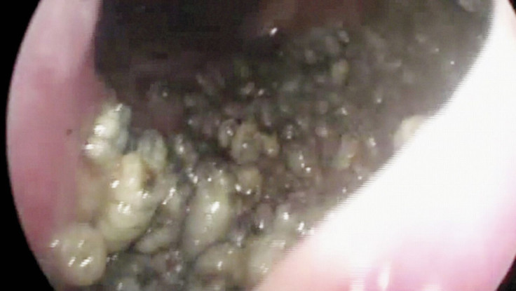Over 100 maggots found in man's nose