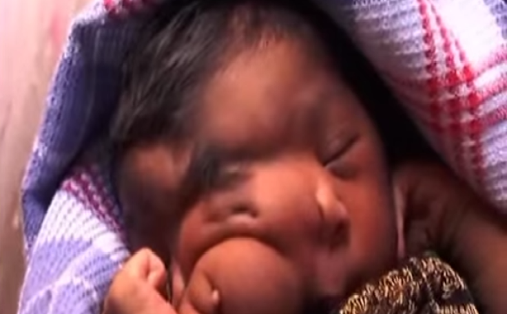 Baby girl in India born with 'elephant trunk'