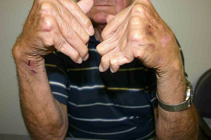 rheumatoid arthritis