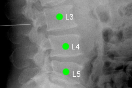 LevelCheck software clearly labels each vertebra in this X-ray image taken just before a patient's spinal surgery. Note the pin to the left of L3. L stands for the lumbar regions of the spine.
