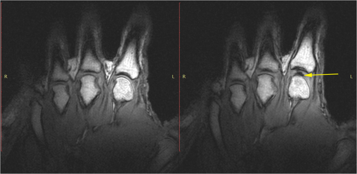 Static images of the hand in the resting phase before cracking 