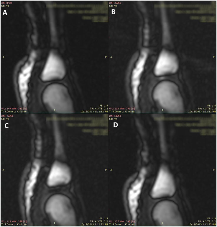 Still frames from a representative trial of joint cracking in the same MCP joint