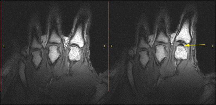 Static images of the hand in the resting phase before cracking