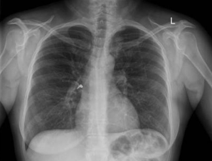 Woman's chest X-ray shows earring in airway leading to lungs
