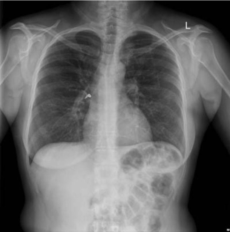 Woman's chest X-ray shows earring lodged in lung