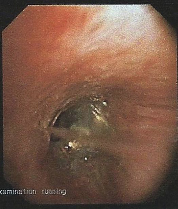 Earring lodged in woman's right bronchus during bronchoscopy