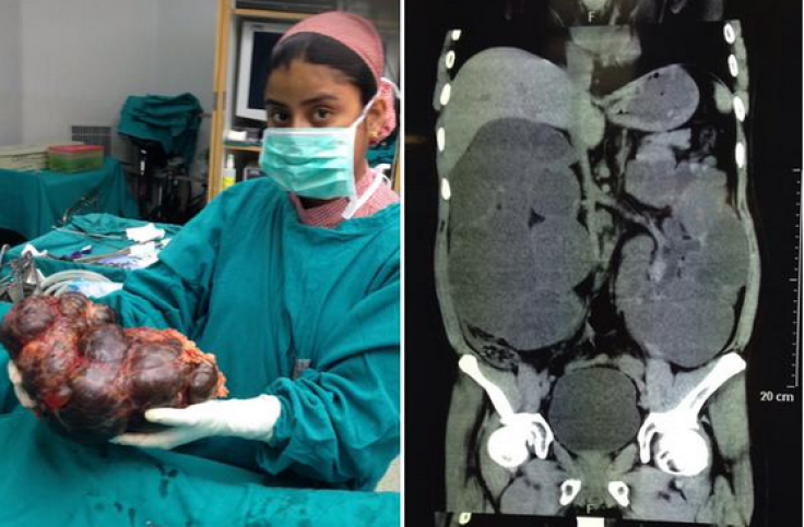 Surgeons extract kidney size of newborn baby