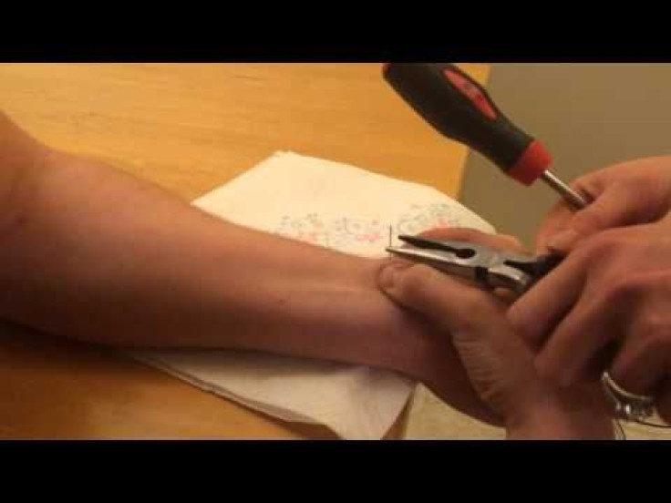 How Not To Pop A Cyst: Man Performs DIY Ganglion Cyst Treatment With Needle And Screwdriver