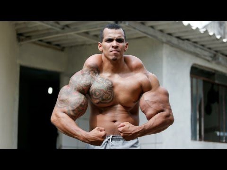 Real-Life 'Incredible Hulk' With 25-Inch Biceps Almost Loses Arms Over Synthol Injections