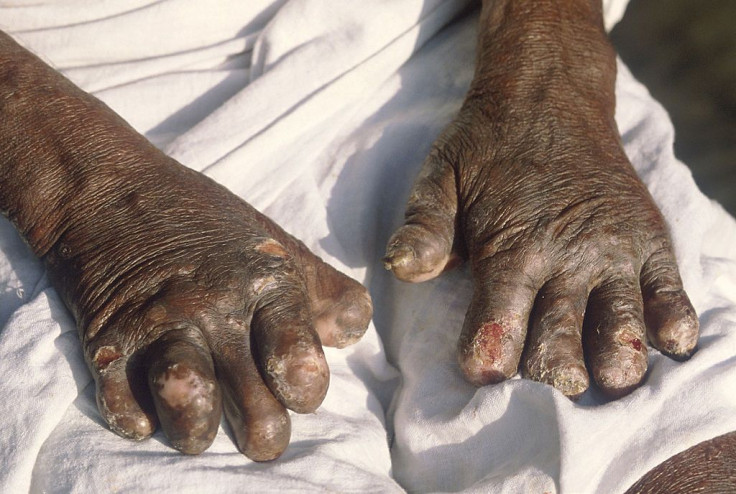 leper hands in India, 1990