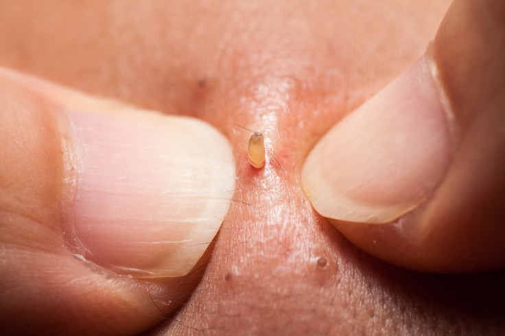 extracting a blackhead