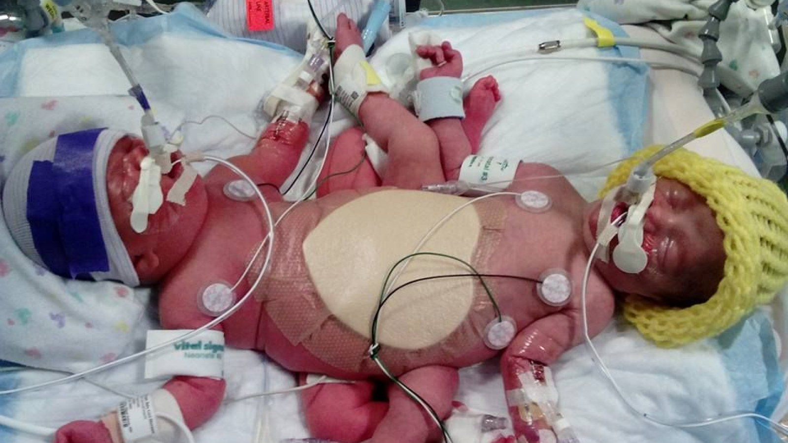 Texas Mom Delivers Conjoined Twins Who Are Also Rare ...