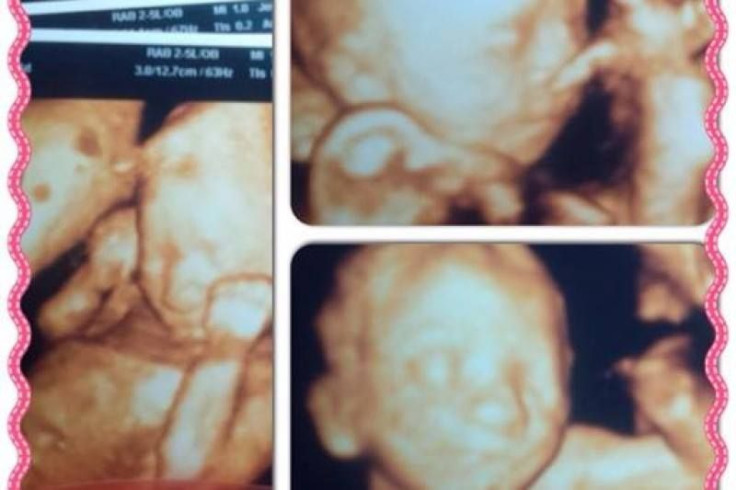 Ultrasound of triplets