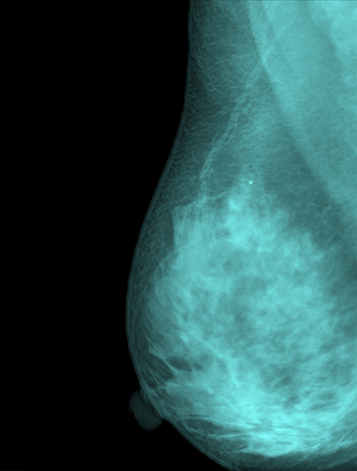 Mammogram