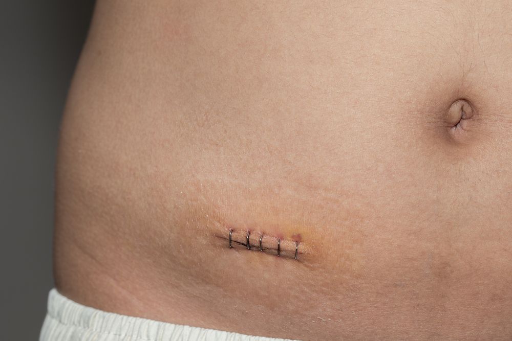 Surgery Cover Up Tattoo | Baseball and Softball Theme