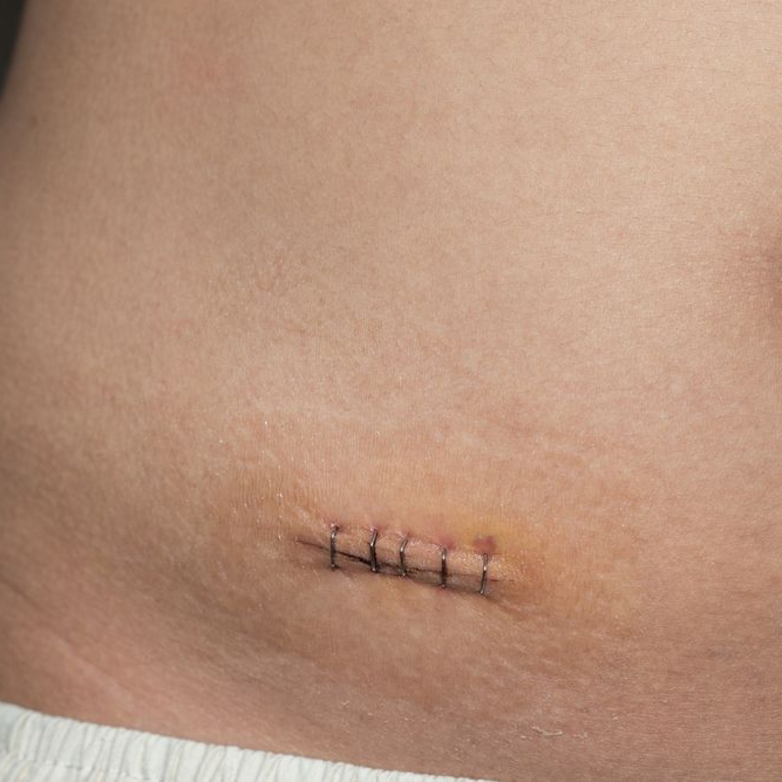 Female Appendix Scars Appendectomy Scar Location Modified Lanz Incision In Appendicectomy