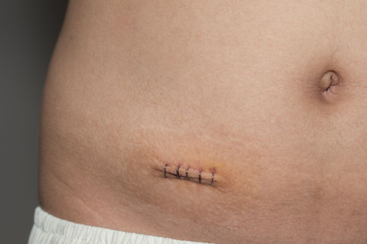 appendectomy scar