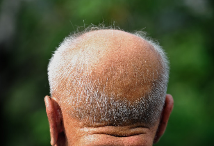 Male Pattern Baldness