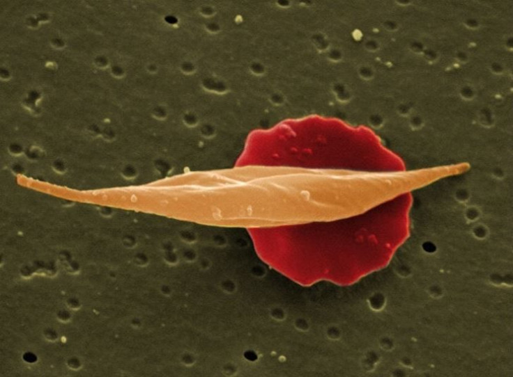 Sickle cell disease