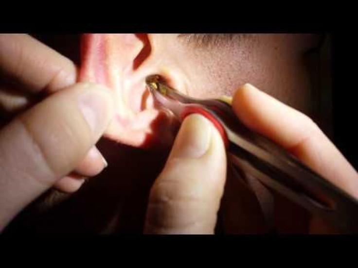 This Guy Removing A Huge Chunk Of Earwax Is Incredibly Gross Yet Satisfying